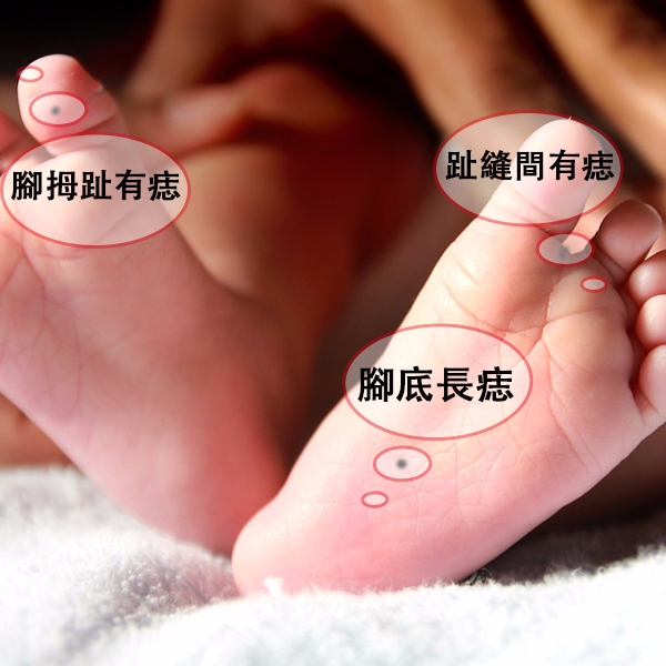 ❀ 腳拇趾有痣
涵義:得名威勢,掌控全局
腳拇指的痣是指腳拇指下方的,因為拇指掌權,是個做領導的人才,而且能夠把權利牢牢控制,對於全局的把握有天生的領悟。
❀ 趾縫間有痣
涵義:旺財之相,主人大發
錢運亨通之人。這種長痣法,暗示錢財存在裡面,所以會很有錢喲~
❀ 腳底長痣
涵義:「峰候帶相」
腳底中心部位的痣,所謂「峰候帶相」,這類的人可以做地方之長,統領一方!