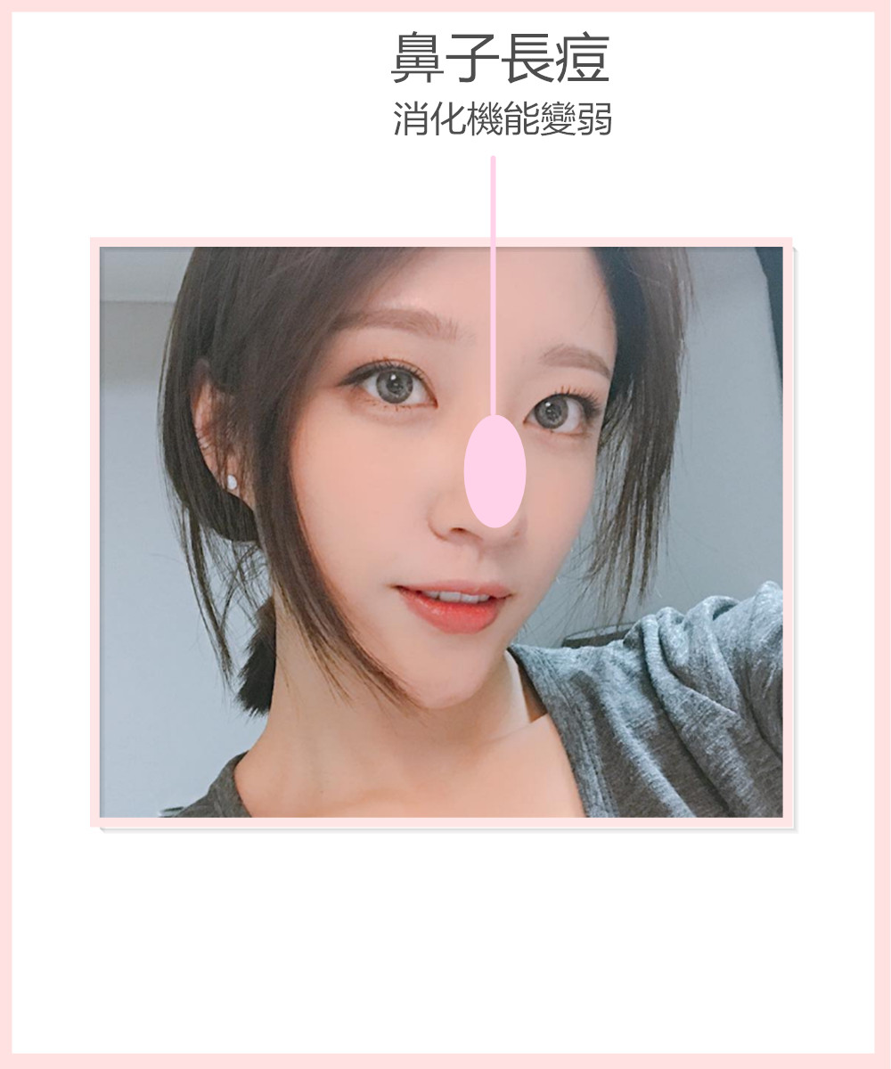鼻子和胃腸、心臟有關聯。鼻子上長痘多是因為消化機能變弱引起的。要避免暴飲暴食和吃夜宵,避免食用辣的或者鹹的刺激性食物、脂肪含量高的食物、咖啡、碳酸飲料等。