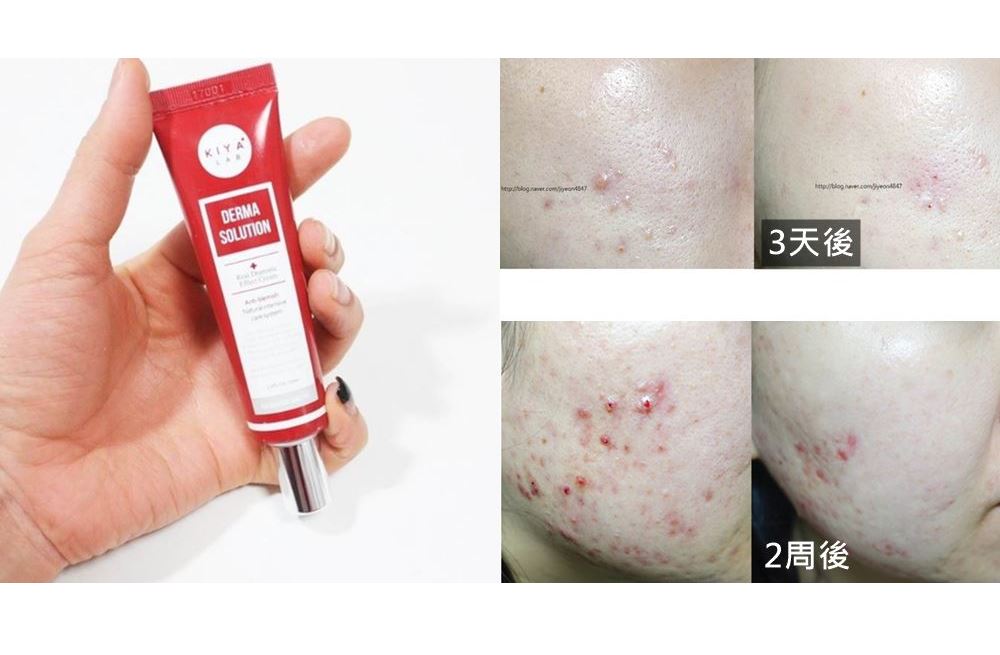 韓國新推出的「流氓去痘膏」一個月就賣2萬個!超夯!它主打用「最少的成分」核心治療痘痘!扣除哩哩雜雜的成分,只取必要的成分,讓肌膚不再受到其他刺激、專心療傷