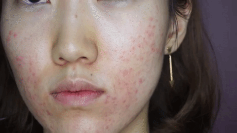 唉唉...看看這些痘痘...,真的是沒藥救了吧?雖然說長痘痘最好的解決方法就是去看醫生、不要化妝沒錯,但是其實有的痘痘是因為內分泌失調引發的,更別提也會有需要化妝的時候啊!